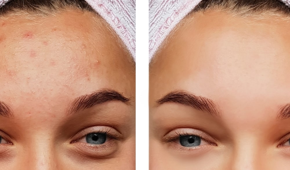 Wie wird Akne behandelt? Tipps & Tricks für eine gesunde Haut