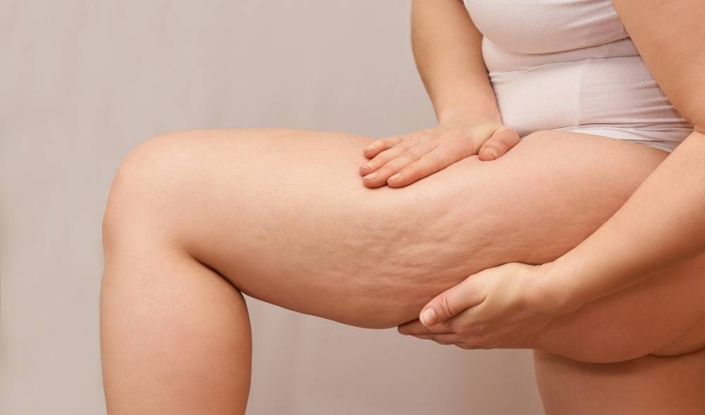 Anti-Cellulite-Guide: Orangenhaut effektiv loswerden